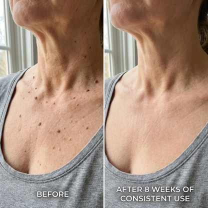 Erona™ KeraClear
