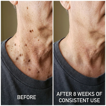 Erona™ KeraClear